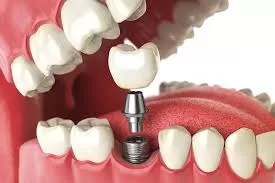 Photo of Full Mouth Dental Implants in St. Charles, IL: Transform Your Smile and Life by Chicago implant Studio