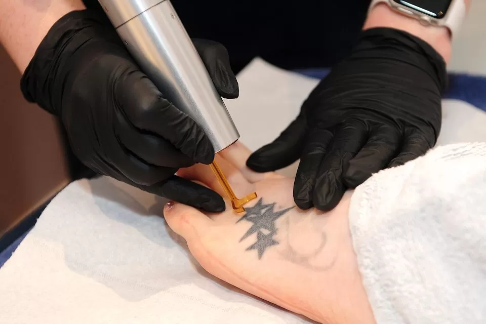 Photo of What Makes Laser Tattoo Removal Different? by healthcare