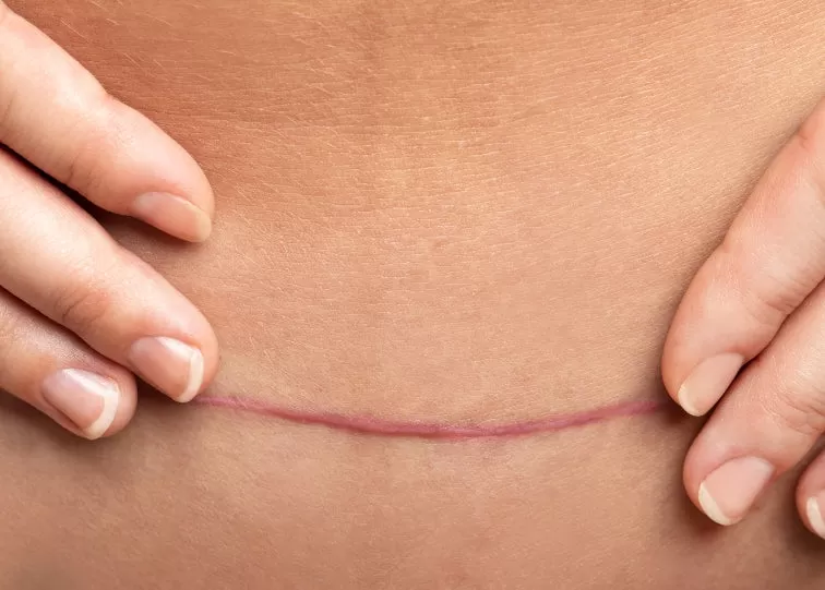 Photo of How Many Sessions Does Laser Scar Removal Need? by healthcare