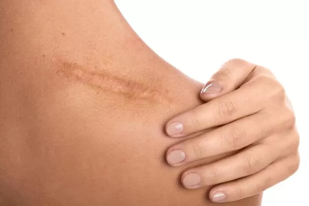 Photo of How Many Sessions Does Laser Scar Removal Need? by healthcare